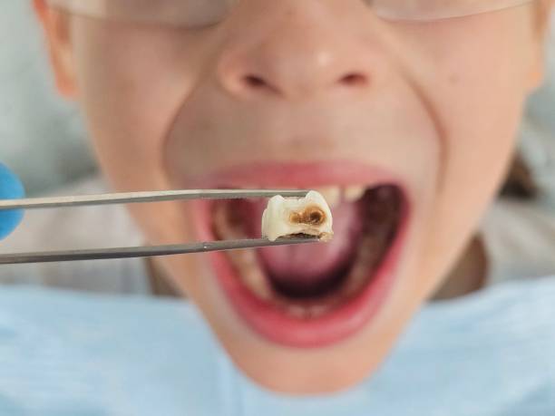 Best Emergency Treatment for Dental Infections or Abscesses in Rolling Fork, MS